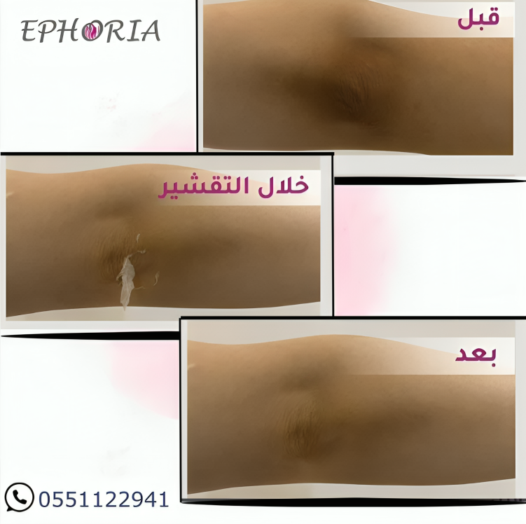 تقشير الجسم في عيادات ايفوريا بالرياض تقشير الجسم في عيادات ايفوريا بالرياض